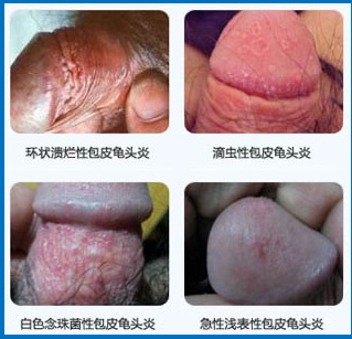 包皮龟头炎